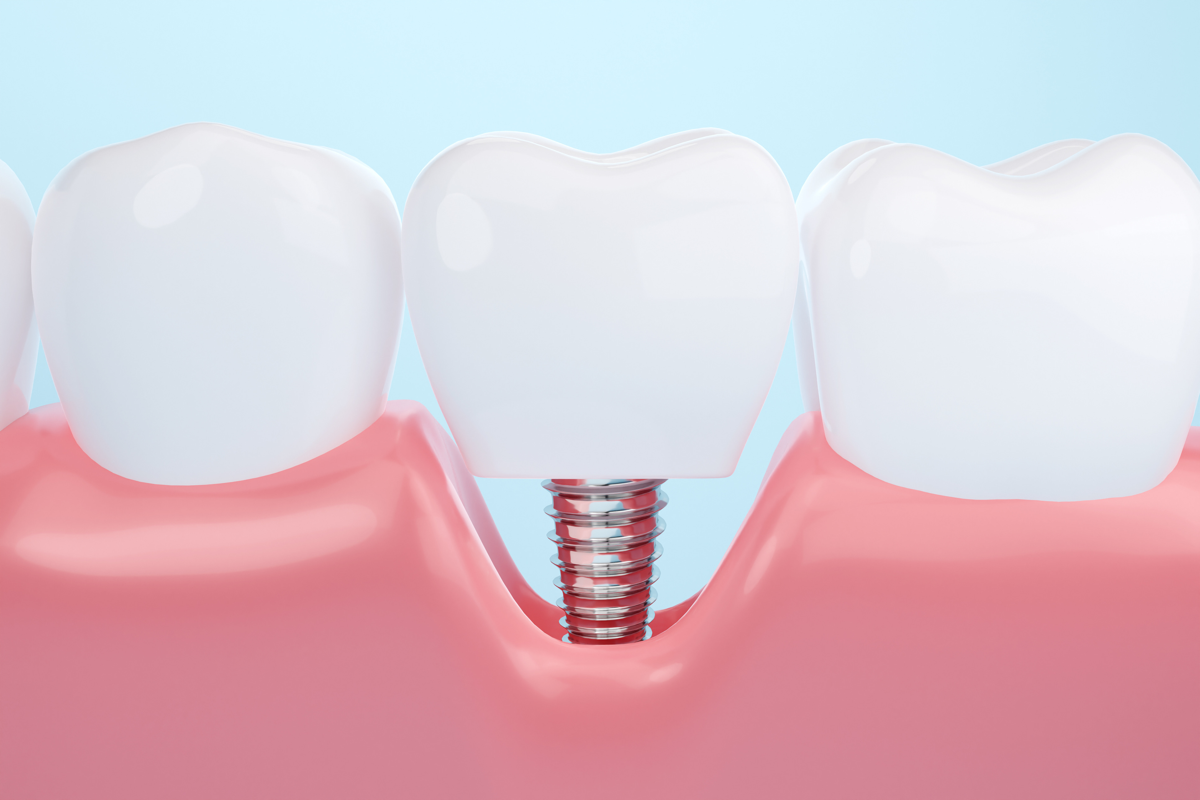 How Do Dental Implants Work?